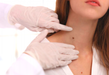 5 Types of Mole Removal Drugs Sold in Pharmacies