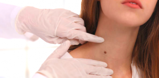 5 Types of Mole Removal Drugs Sold in Pharmacies